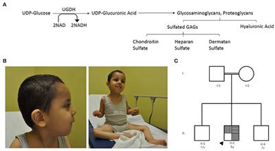 A Missense Mutation in the UGDH Gene Is Associated With Developmental Delay and Axial Hypotonia